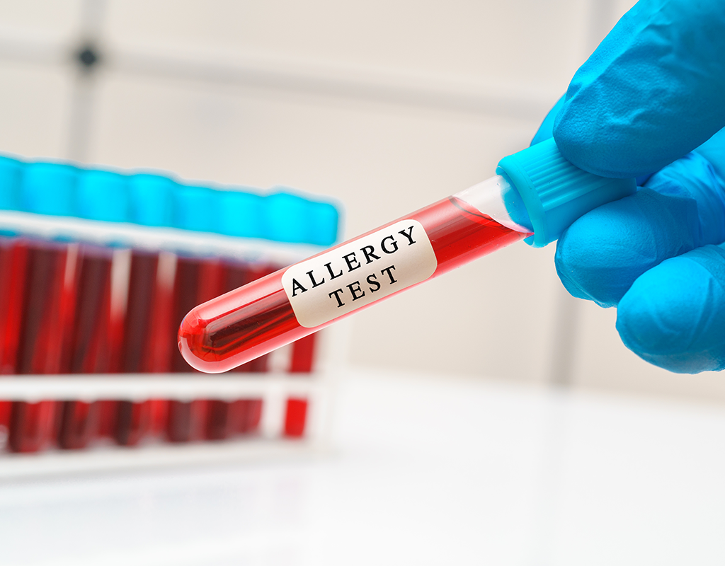 Allergy Tests - NOVALAB CORP NJ Reference Medical Diagnostic Laboratory